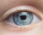 Low-dose atropine eyedrops not effective in slowing myopia progression in children