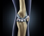 Cleveland Clinic London performs first augmented reality-assisted total knee replacement